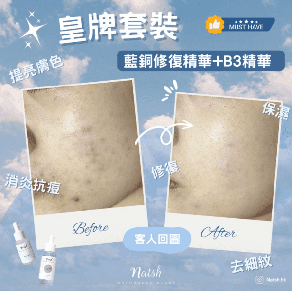 <span style="color: #003300;"><strong>皇牌精華套裝!</strong></span> <span style="font-size: 90%;">有粒粒問題？毛孔粗大、有黑頭粉刺 ？皮膚乾燥到甩皮 ？</span> <span style="font-size: 90%;">唔洗再煩惱啦，皇牌組合一 set 幫你攪掂晒！</span> <span style="font-size: 90%;">⊎  capacity: 30m per</span> <span style="font-size: 90%;">ö  preservative-free / vegan / cruelty-free / all skin type</span> Natshhk