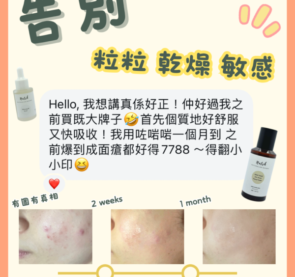 NATSH抗痘